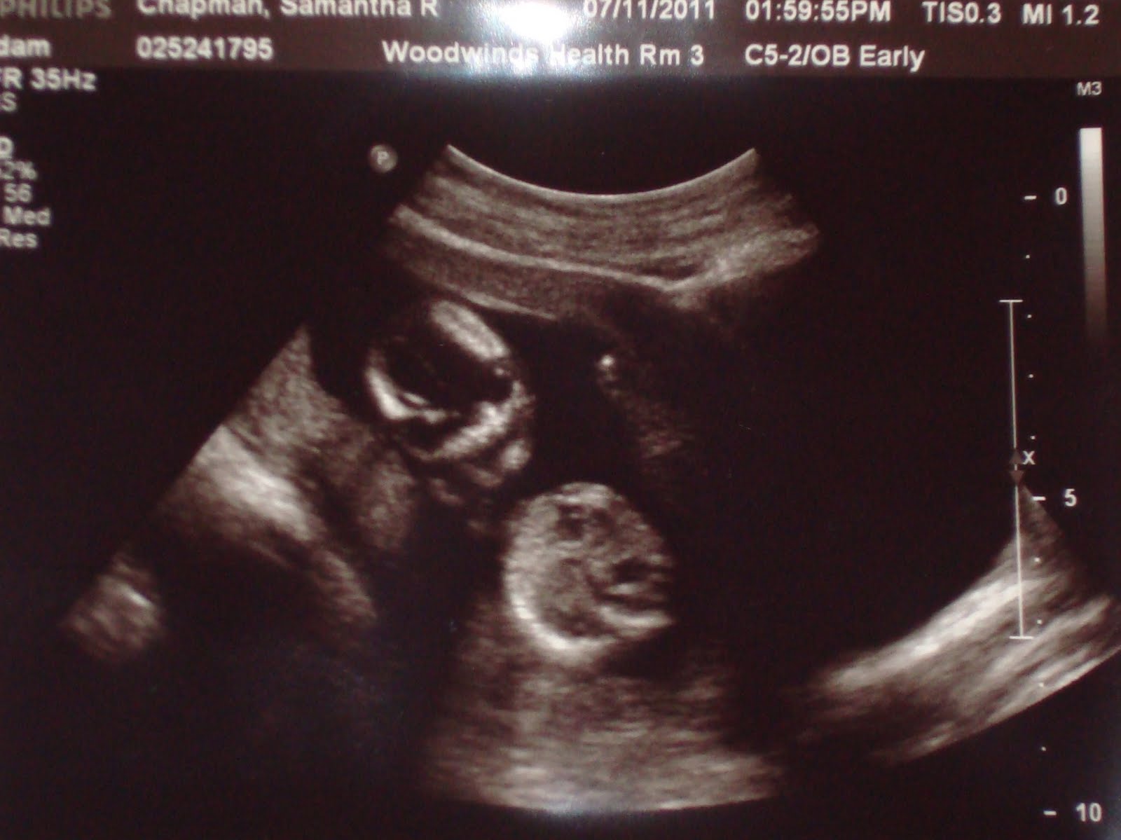 real-life-a-mn-mom-14-weeks-5-days-pregnant-appointment-ultrasound
