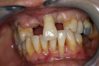 Implantes dentários em Lisboa