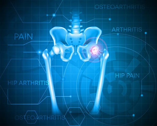 Arthritis Hip Pain