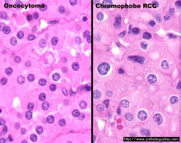 Brady Urology at Johns Hopkins Hospital: Oncocytoma: A Benign Kidney ...