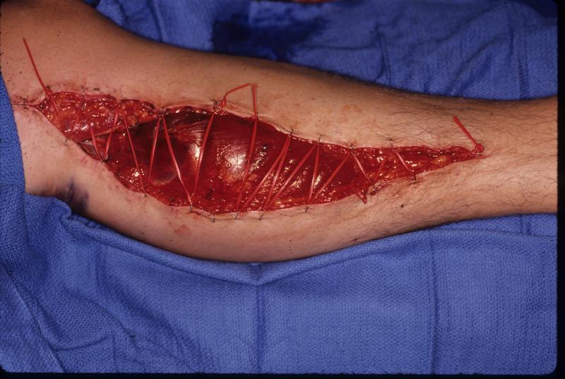 Wound Infection Treatment & Management: Approach ...