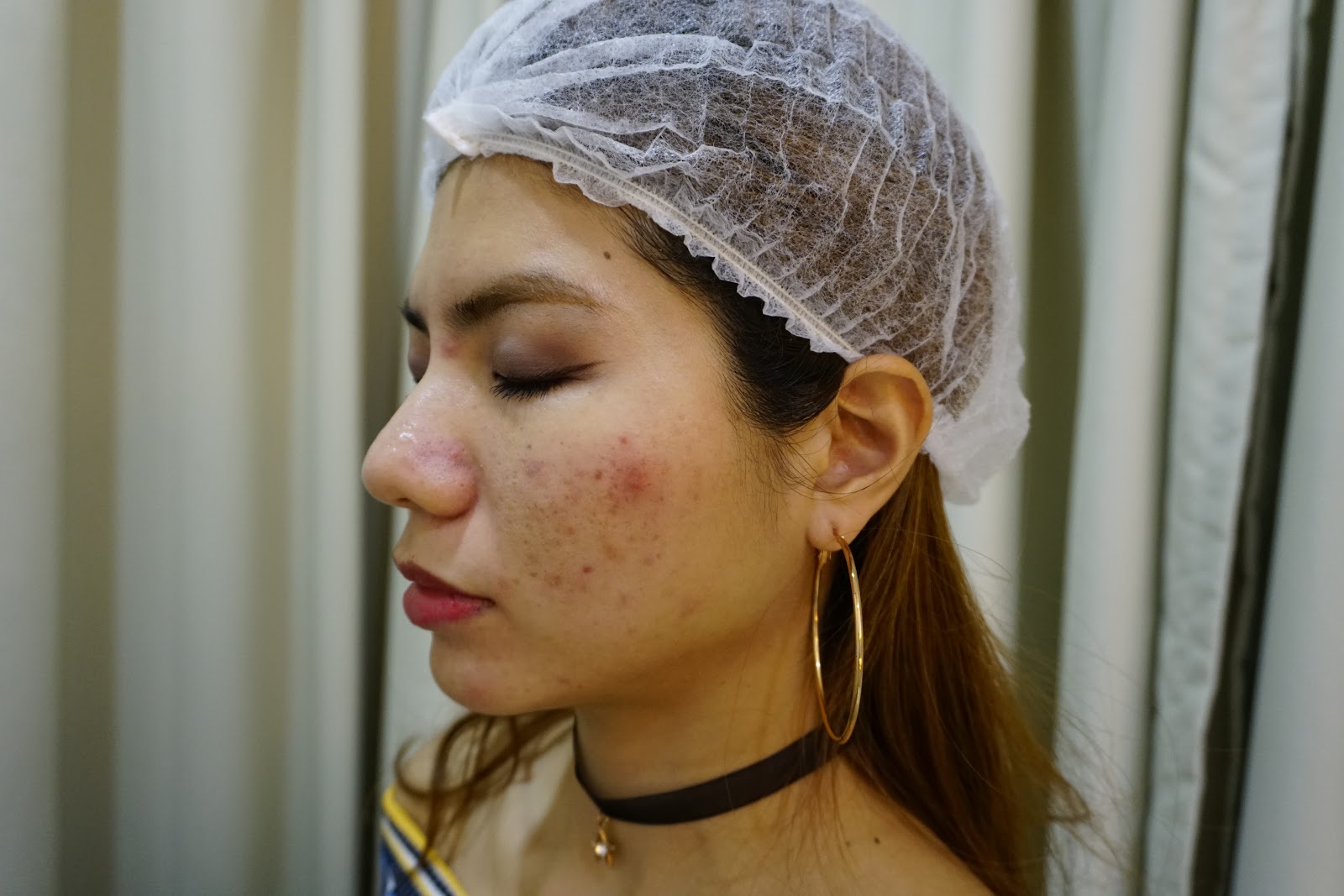 Laser for Acne Dual Yellow Laser Skin Gym SS2 J & D Learn to Blog