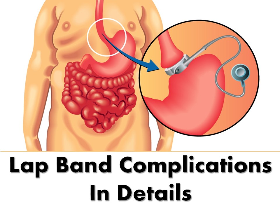 All You Need To Know About Lap Band Surgery