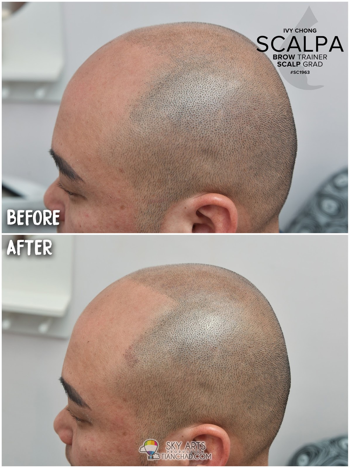 Best Scalp Micropigmentation Smp In Malaysia Smp 让你不再为