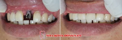 có nên cắm ghép răng implant không -8 có nên cắm ghép răng implant không -8