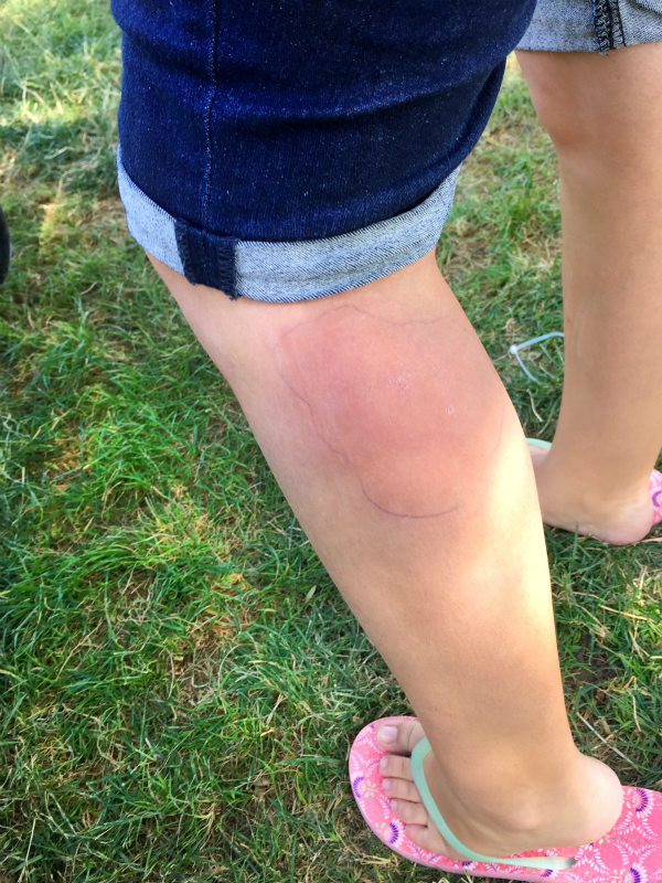 How We Battled an Allergic Reaction to Mosquito Bites