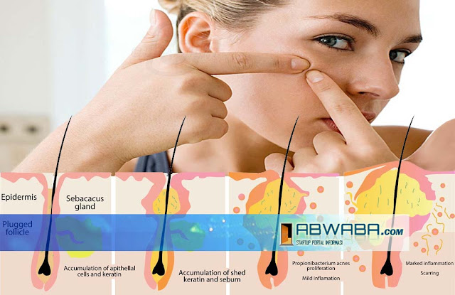 Solusi Jerawat ( Pencegahan Dan Pengobatan ) Tips Kecantikan dan Kesehatan Wanita Terlengkap