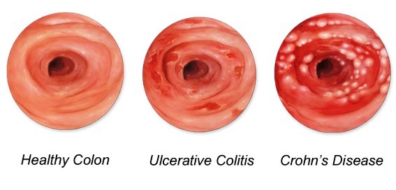 Normal Bowel, Ulcerative Colitis and Crohn's Disease