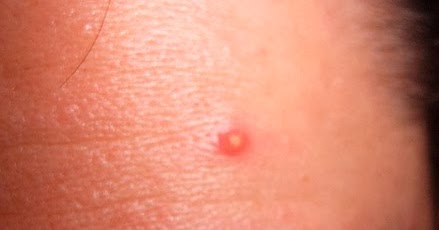Natural Ways To Pop Pimples Natural Ways To Pop Pimples