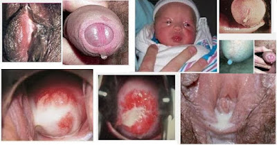 gejala kencing nanah dan penularan pada bayi