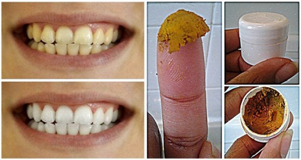 SEA SU PROPIO DENTISTA! CURAR LAS CARIES, ENFERMEDAD DE LAS ENCÍAS, Y BLANQUEAR LOS DIENTES CON PASTA DE DIENTES ESTE NATURAL HECHO EN CASA !!! SEA SU PROPIO DENTISTA! CURAR LAS CARIES, ENFERMEDAD DE LAS ENCÍAS, Y BLANQUEAR LOS DIENTES CON PASTA DE DIENTES ESTE NATURAL HECHO EN CASA !!!