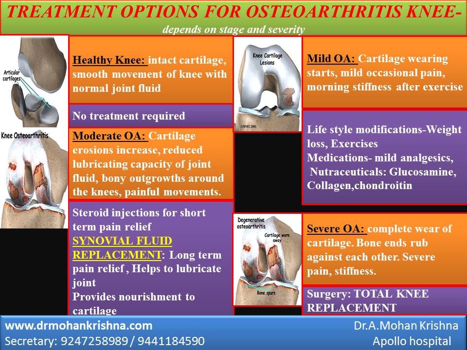 ORTHOPEDIC DOCTOR Synovial fluid replacement therapy