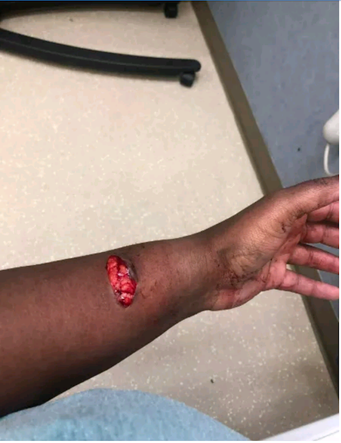 Pit bull inflicts horrific injury on its owner but she refuses to put it down (graphic photos) Pit bull inflicts horrific injury on its owner but she refuses to put it down (graphic photos)