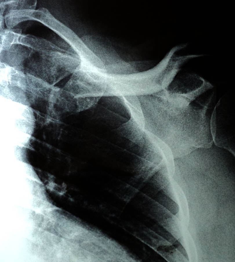 O R T O C R I T I C A: FRACTURA DE TERCIO PROXIMAL DE CLAVICULA