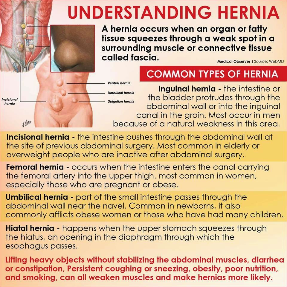 Funny Jokes LOL understanding hernia