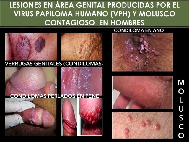 Papiloma humano en hombres tratamiento