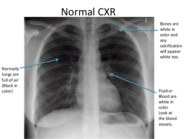 physio knowledge bd chest x ray chest xray