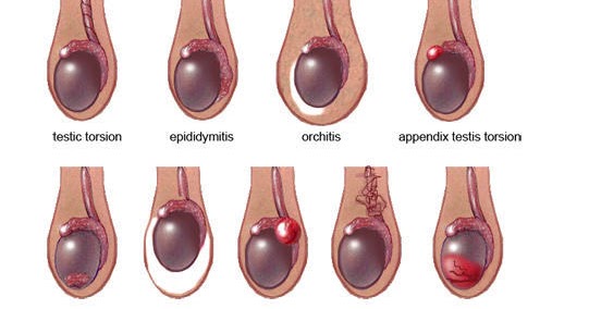 тянущая боль правого яичка. варикоцеле – расширение вен семенного канатика. варикоцеле варикоз семенников. воспаление придатка яичка. воспаление яичка у мальчика.