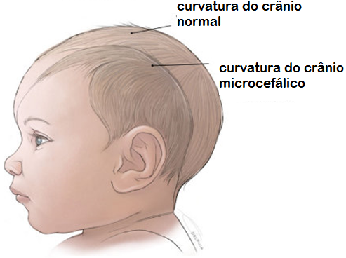 comparação crânio normal e de uma criança com microcefalia 