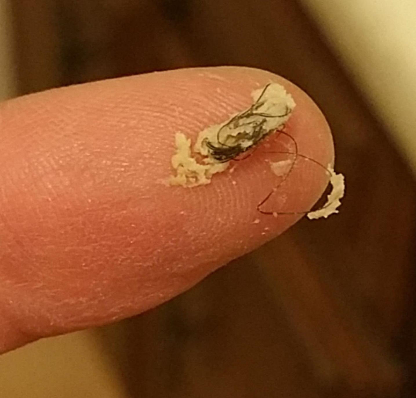 Mr. ZIT Most 10 Shocking Popping Photo ! (Zits , Pimples