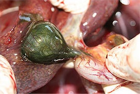 Extirpación De La Vesícula Biliar Del 10-15 por ciento de las personas experimentan dolor abdominal superior después de la extirpación de la vesícula biliar.