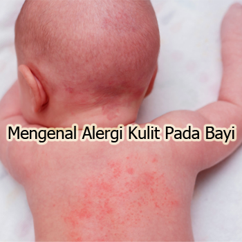 Mengenal Alergi Kulit Pada Bayi