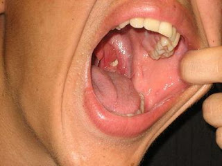 Amidan sưng to 1 bên Amidan sưng to 1 bên