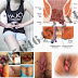 Mengobati Bibir Anus Bengkak, Perih dan Gatal thumbnail