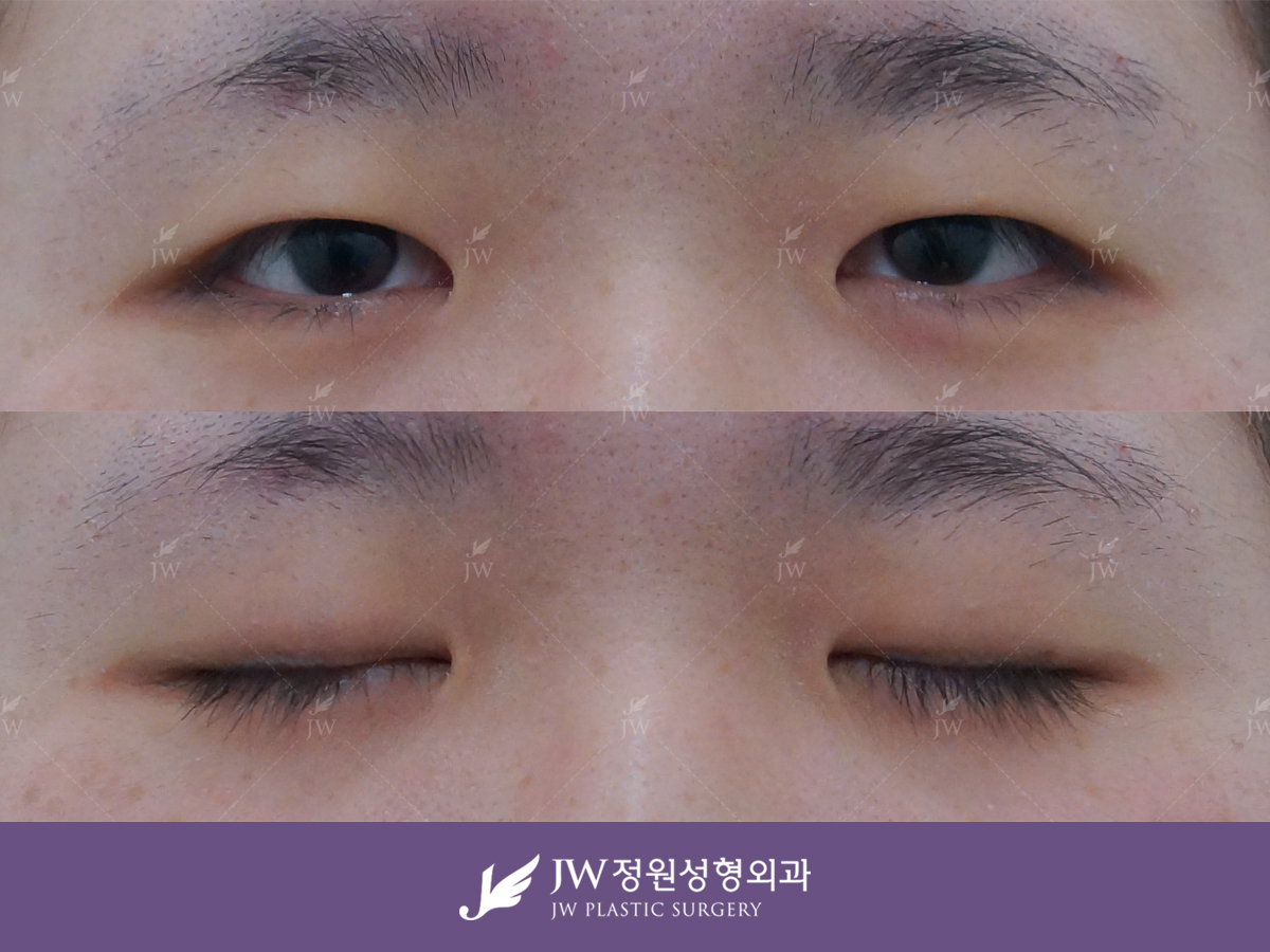 Черные глаза операция. Блефаропластика азиатских глаз. Пластическая операция в Корее на глаза птоз. Эпикантус до и после операции Корея. Корейцы операция на веках до и после.