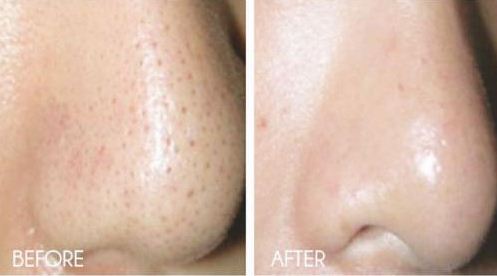 Get Rid Of Large Pores On Face