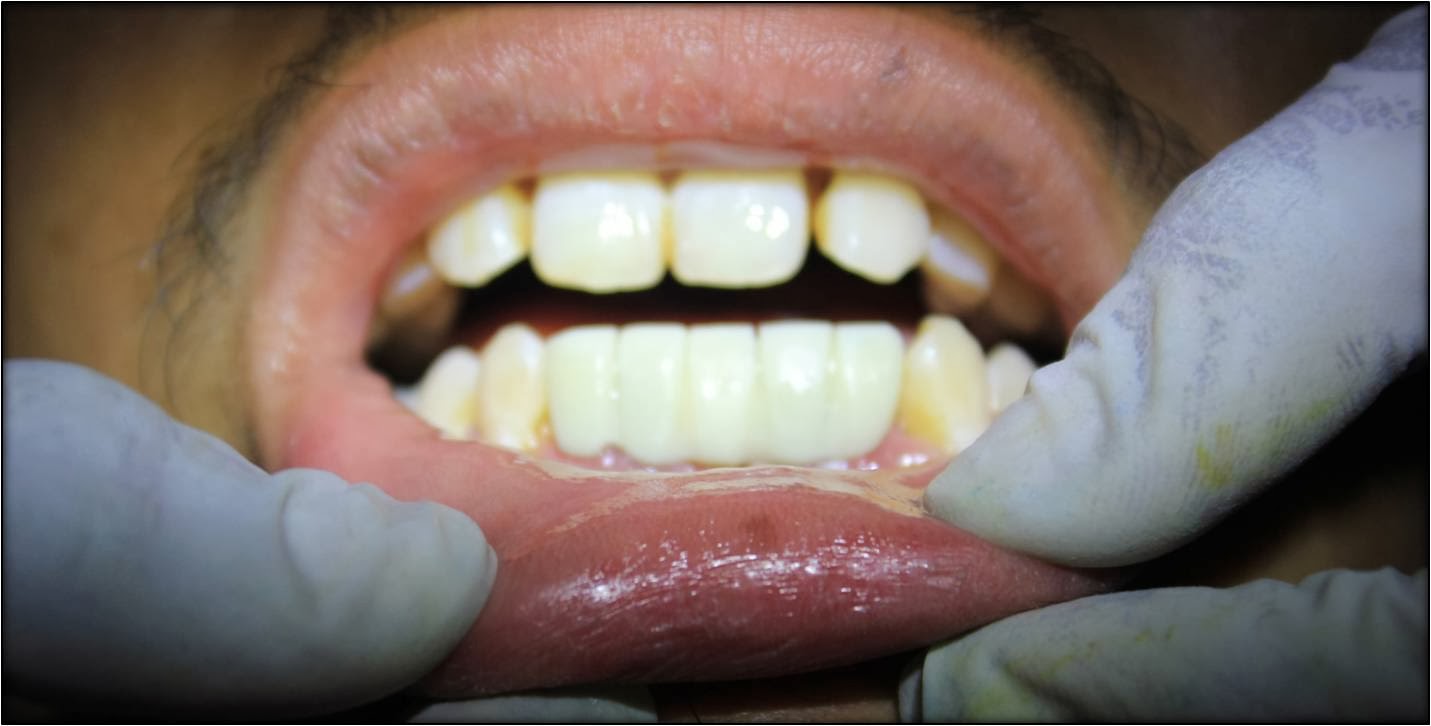 LOOSE BOTTOM FRONT TEETHTreatment by affordable dental implants and