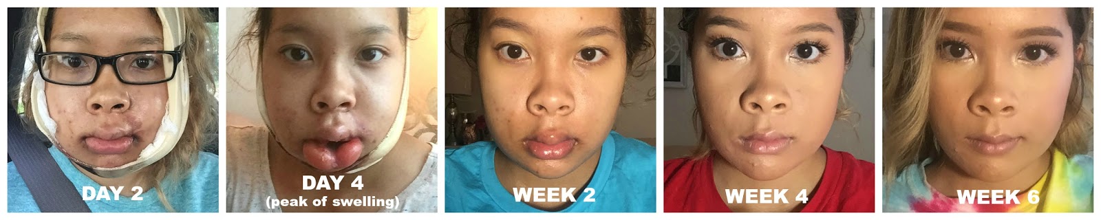 my double jaw surgery recovery experience seoulful sydney underbite surgery