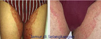 Obat Gatal Mujarab Karena Jamur pada Selangkangan Paha, obat gatal pada selangkangan dan bokong alami, nama obat gatal selangkangan gatal dan hitam tablet
