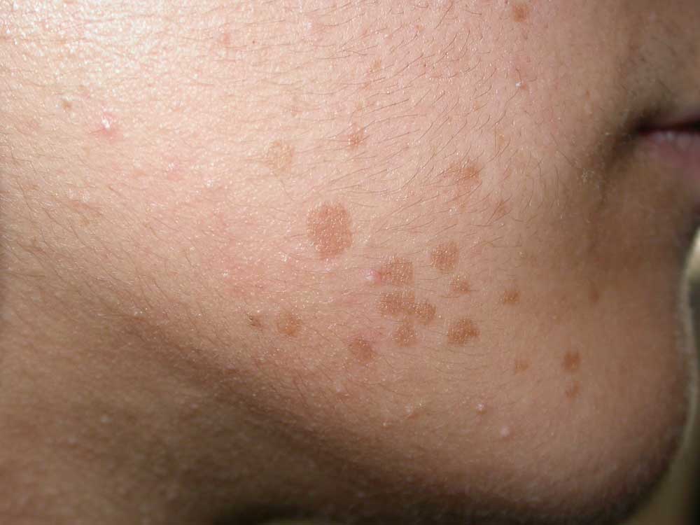 Blog Clínica Dermatológica Dr. E. Herrera Verrugas, ¿son