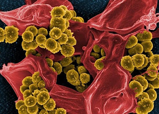 What is Dysplasia ? - The Progression of Cancer What is Dysplasia ? - The Progression of Cancer