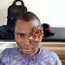 OMG: See Photos Of Man With Eye Cancer In Benue State - Viewers' Discretion Advised