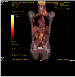 Pet Scan Image (One sample level of many)