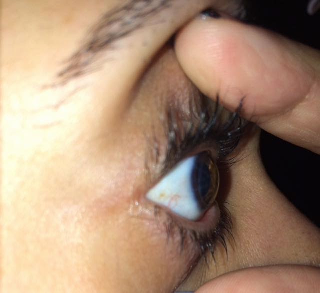 Right eye with corneal transplant