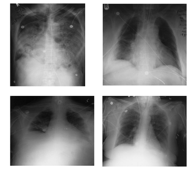 dokter Andrie Gunawan: Syndroma Gagal Nafas Akut (ARDS)