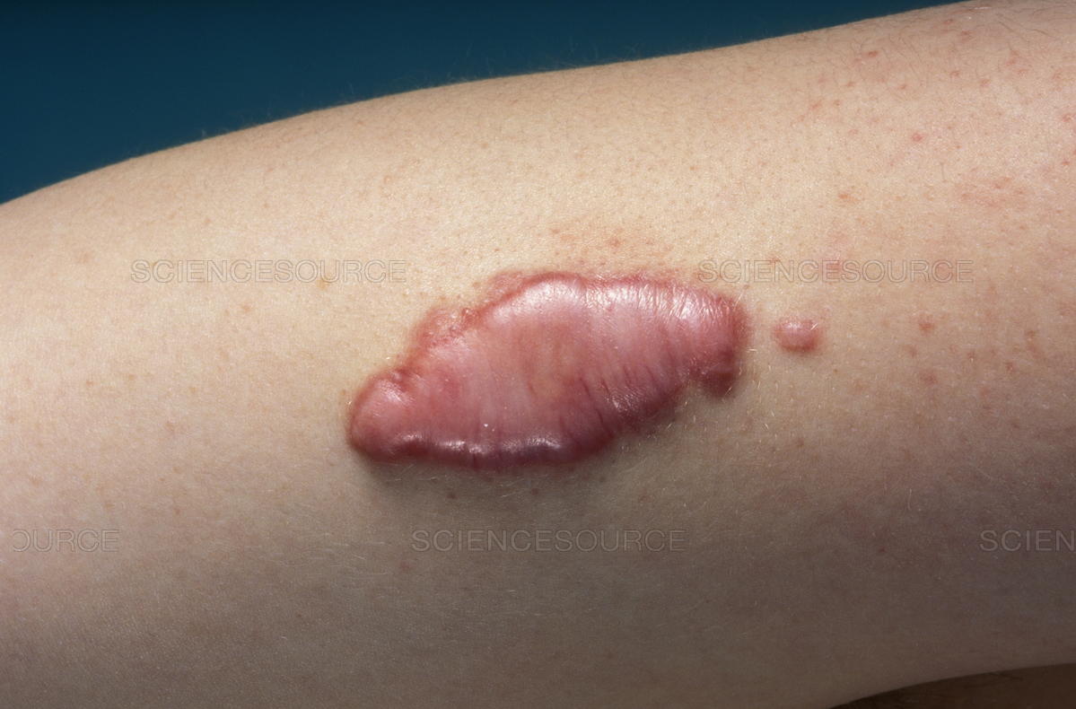 Cara Menghilangkan Keloid yang Sudah Menahun Cara Menghilangkan Keloid yang Sudah Menahun