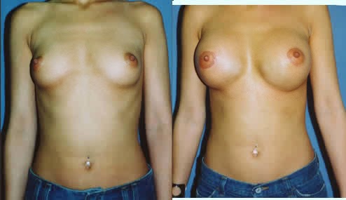 crescent mastopexy with breast augmentation