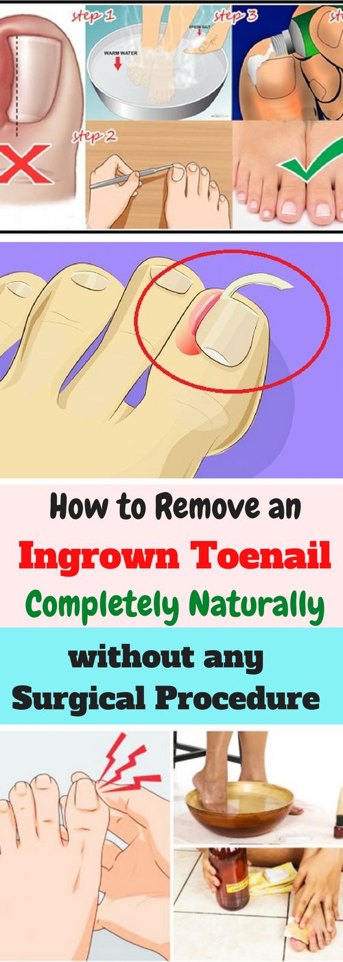How to Remove an Ingrown Toenail Completely Naturally without any
