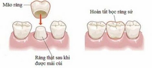 RĂNG SỨ CÓ THAY THẾ RĂNG THẬT ĐƯỢC KHÔNG -2
