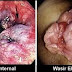 Obat Wasir Kronis Tradisional Manjur thumbnail