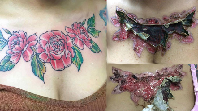 Thai Student Left with A Horrible Scars after Applying Tattoo Remover Thai Student Left with A Horrible Scars after Applying Tattoo Remover