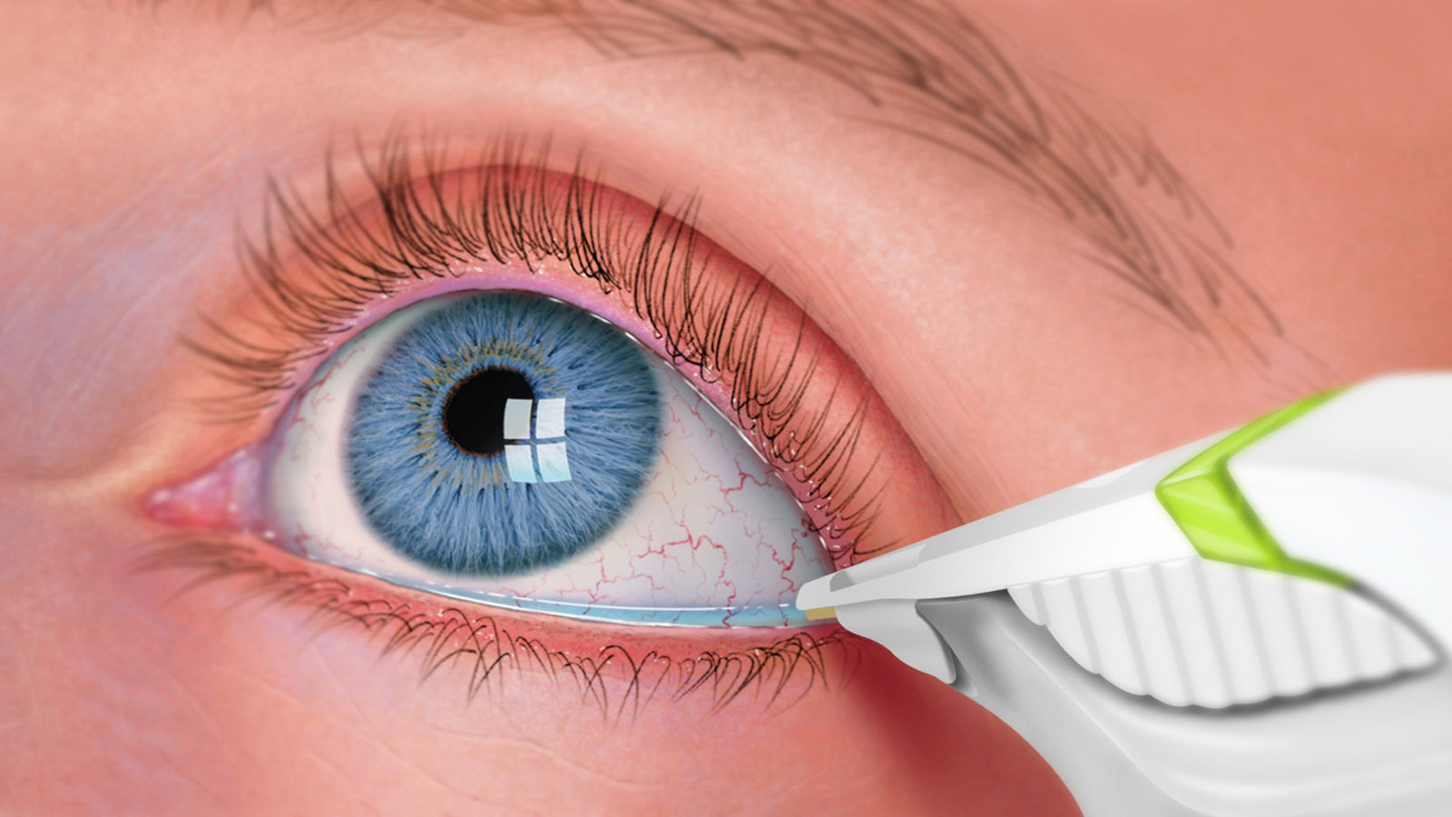 What are the steps of an eyelid surgery procedure? EYE