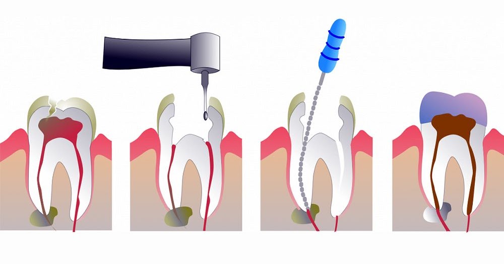 PULPECTOMY procedures in primary molar teeth odontobebe