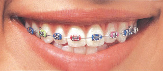 Behel,LHDentalCareMedan,Orthodontic