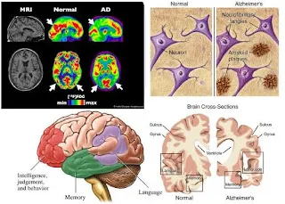 Anatomi otak penderita alzheimer, Gejala awal dan pencegahan alzheimer