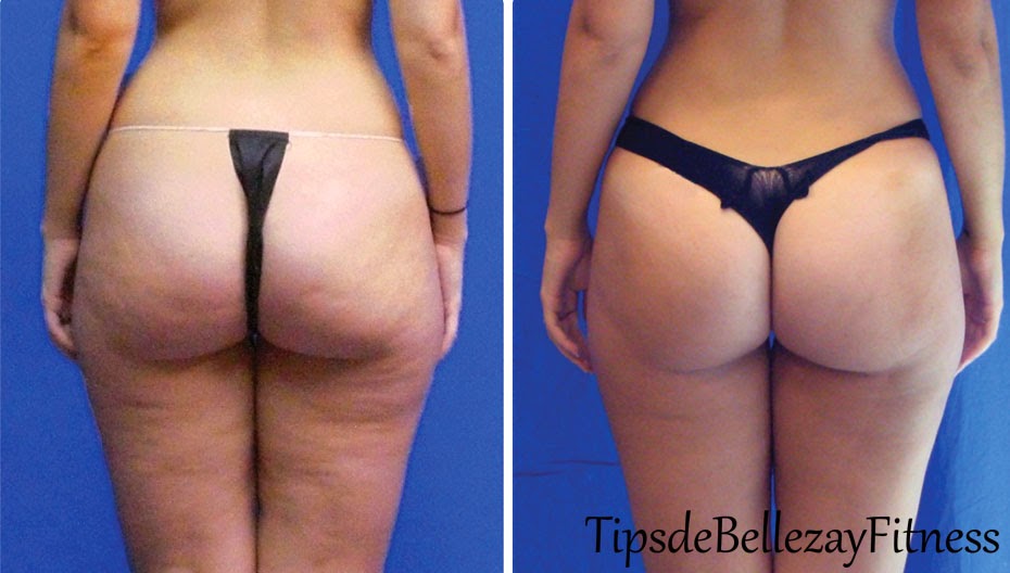 celulitis fotos de antes y despues celulitis fotos de antes y despues